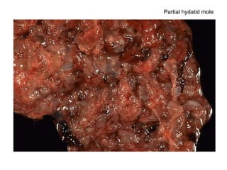 Partial hydatid mole