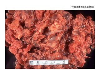 Hydadid mole, partial