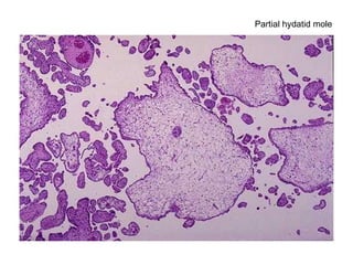 Partial hydatid mole