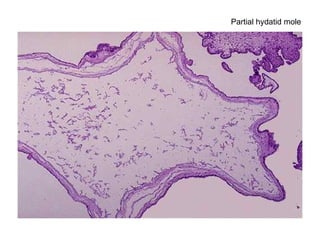 Partial hydatid mole