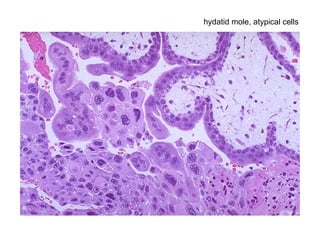 hydatid mole, atypical cells