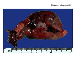 Ruptured tubar gravidity