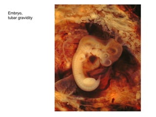 Embryo, tubar gravidity