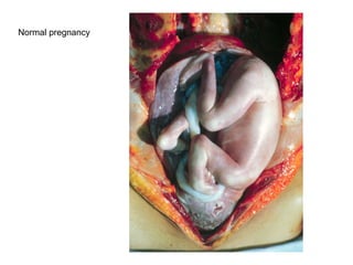 Normal pregnancy