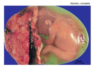 Abortion, complete