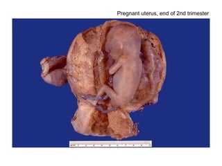 Pregnant uterus, end of 2nd trimester
