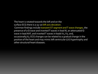 The heart is rotated towards the left and on the
surface ECG there is a 15–20 left axis deviation.
Common ﬁndings include transient ST segment andT wave changes, the
presence of a Q wave and invertedT waves in lead III, an attenuated Q
wave in lead AVF, and invertedT waves in leadsV1,V2, and,
occasionally,V3. ECG changes can be related to a gradual change in the
position of the heart and may mimic left ventricular (LV) hypertrophy and
other structural heart diseases.
 