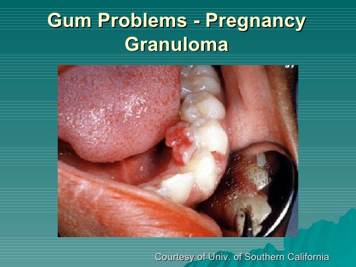 Pregnancy And Your Oral Health