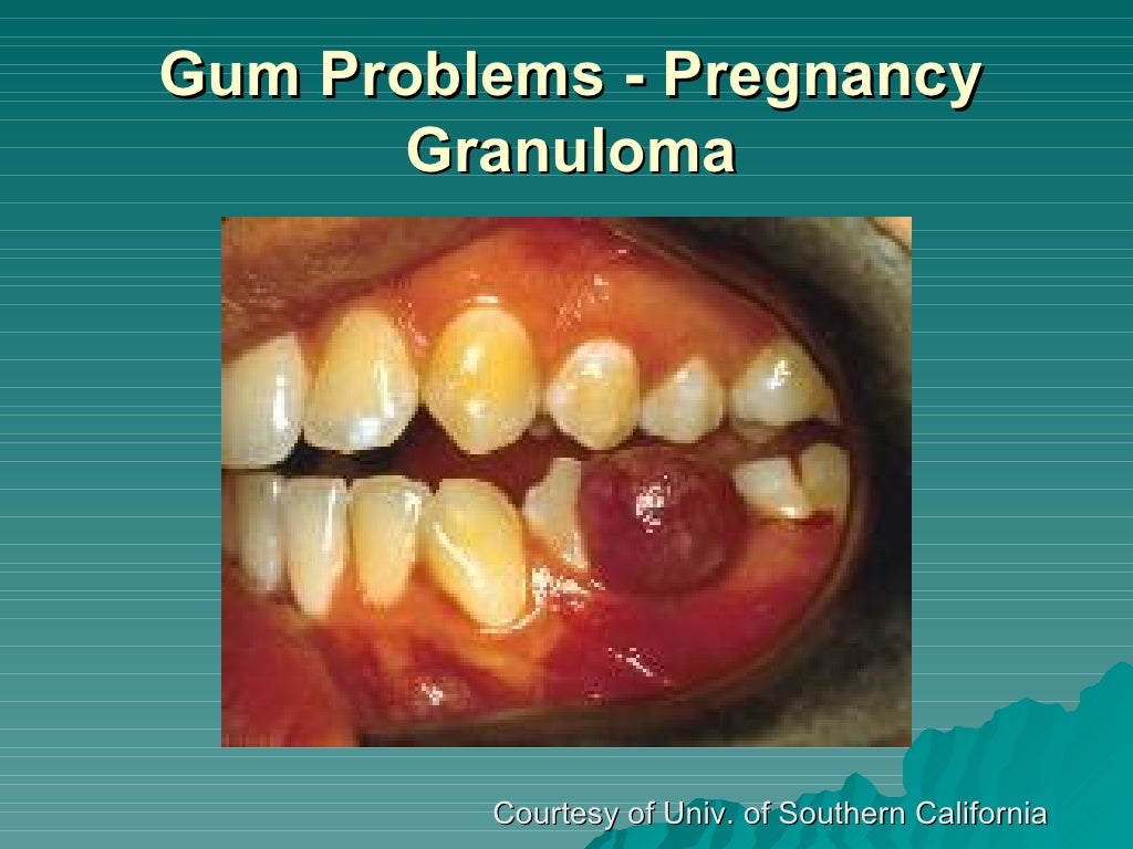 Pregnancy And Your Oral Health