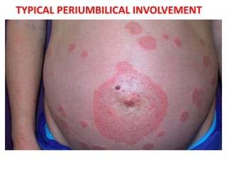 Pregnancy Dermatoses | PPTX