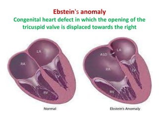 Ebstein's anomaly
Congenital heart defect in which the opening of the
tricuspid valve is displaced towards the right

 
