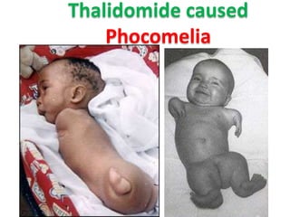 Thalidomide caused
Phocomelia

 