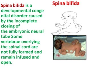 Spina bifida is a
developmental conge
nital disorder caused
by the incomplete
closing of
the embryonic neural
tube Some
vertebrae overlying
the spinal cord are
not fully formed and
remain infused and
open.

Spina bifida

 