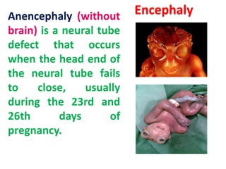 Anencephaly (without
brain) is a neural tube
defect that occurs
when the head end of
the neural tube fails
to
close,
usually
during the 23rd and
26th
days
of
pregnancy.

Encephaly

 
