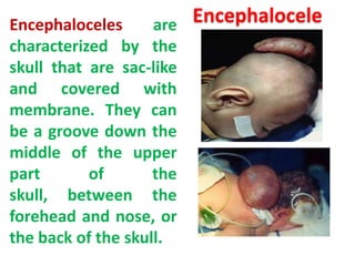 Encephalocele
are

Encephaloceles
characterized by the
skull that are sac-like
and covered with
membrane. They can
be a groove down the
middle of the upper
part
of
the
skull, between the
forehead and nose, or
the back of the skull.

 