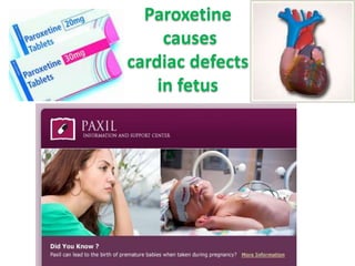 Paroxetine
causes
cardiac defects
in fetus

 