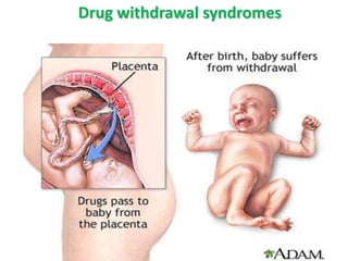 Drug withdrawal syndromes

 