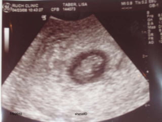 Stage 3: Implantation Begins0.1 - 0.2 mm4 days post-ovulationAbout four days after fertilization, the egg enters the uterine cavity.Cell division continues, forming a cavity in the center of the egg. Cells flatten and compact on the inside of the cavity.The entire structure is now called a blastocyst.7/4/2010shenellD