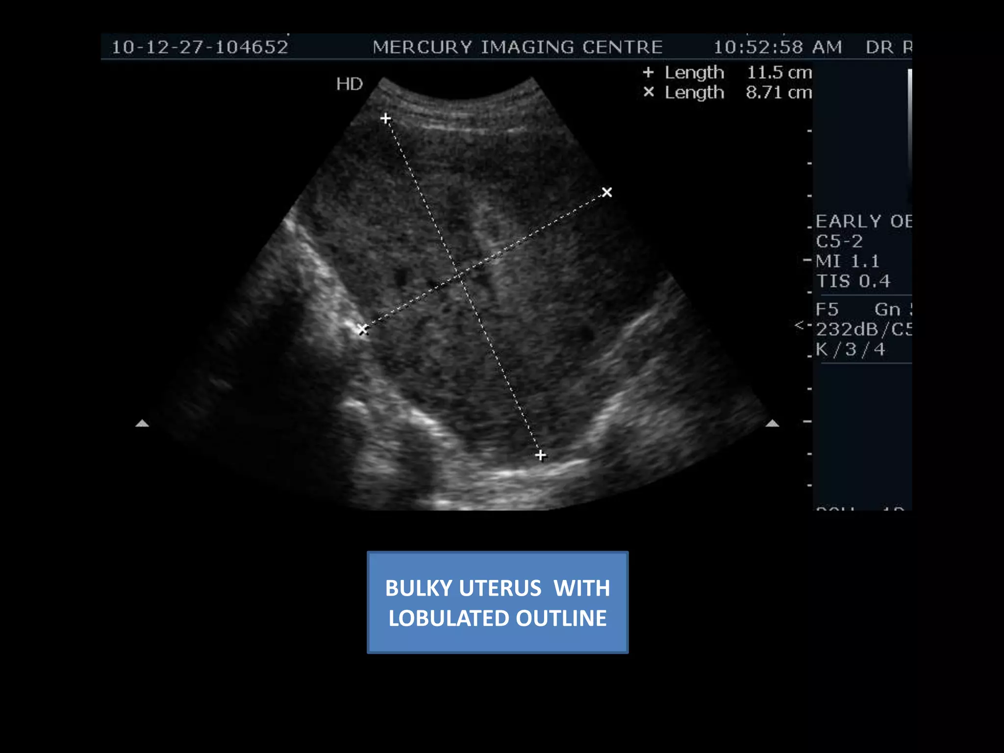 G sac – 5wks with                    ? Viability----Follow up advised . INCREASED INTRAMYOMETRIAL   VASCULATURE PENETERATING PATTERN 