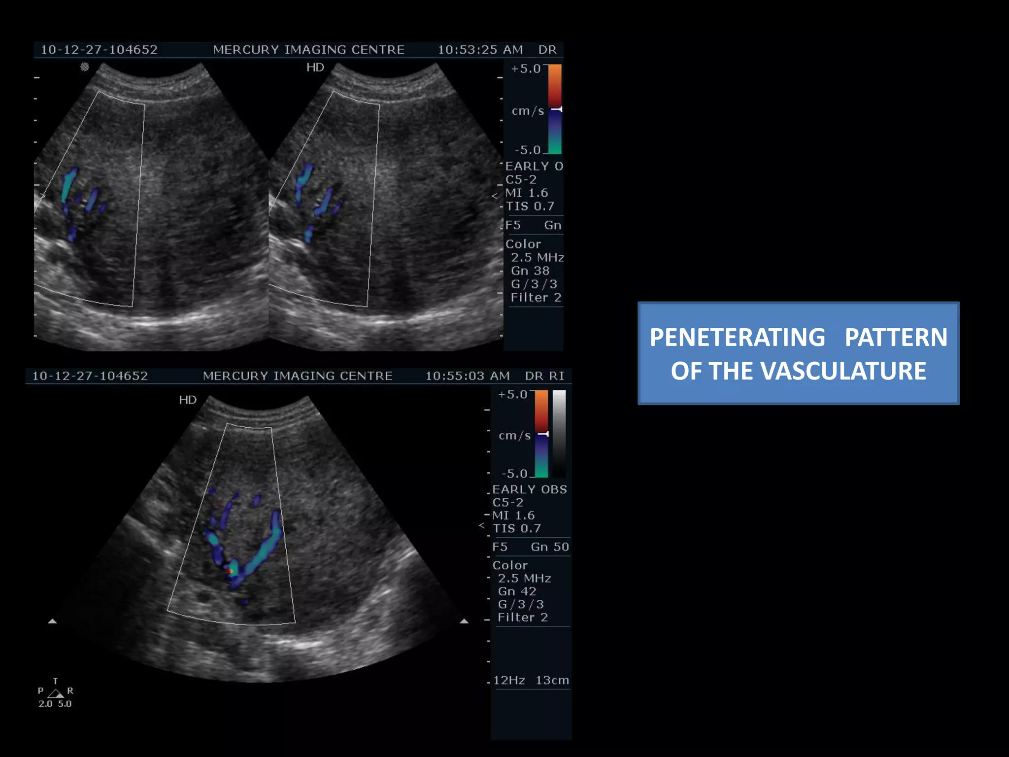 CONGESTED TORTUOUS VESSELS – INTRAMYOMETRIAL . PENETERATING PATTERNFOCAL HYPOECHOIC AREAS APPRECIATED IN THE MYOMETRIUM WITH DEFINED BORDERS – CORROBORATIVE WITH  SMALL LEIOMYOMA.