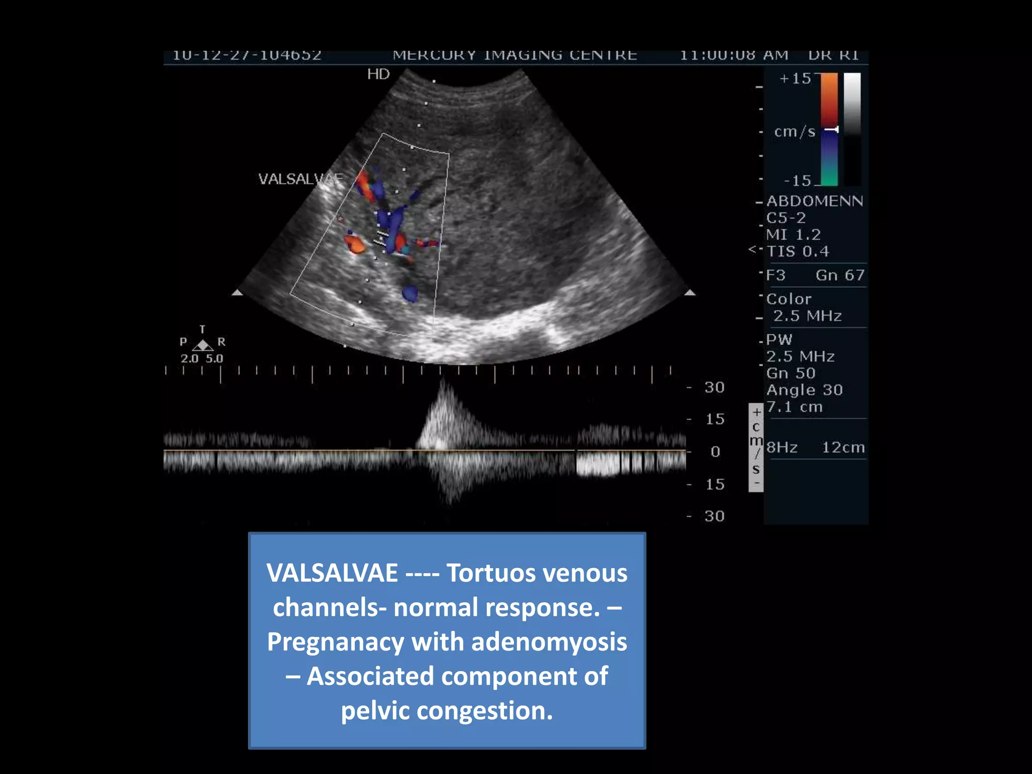 G SAC WITH NO FETAL NODE/ NO YOLK SAC. CORROBORATES WITH POG 5WKS ODAYS ......FOLLOW UP FOR VIABILITY  HETEROGENOUS  ECHOPATTERN OF THE MYOMETRIUM 