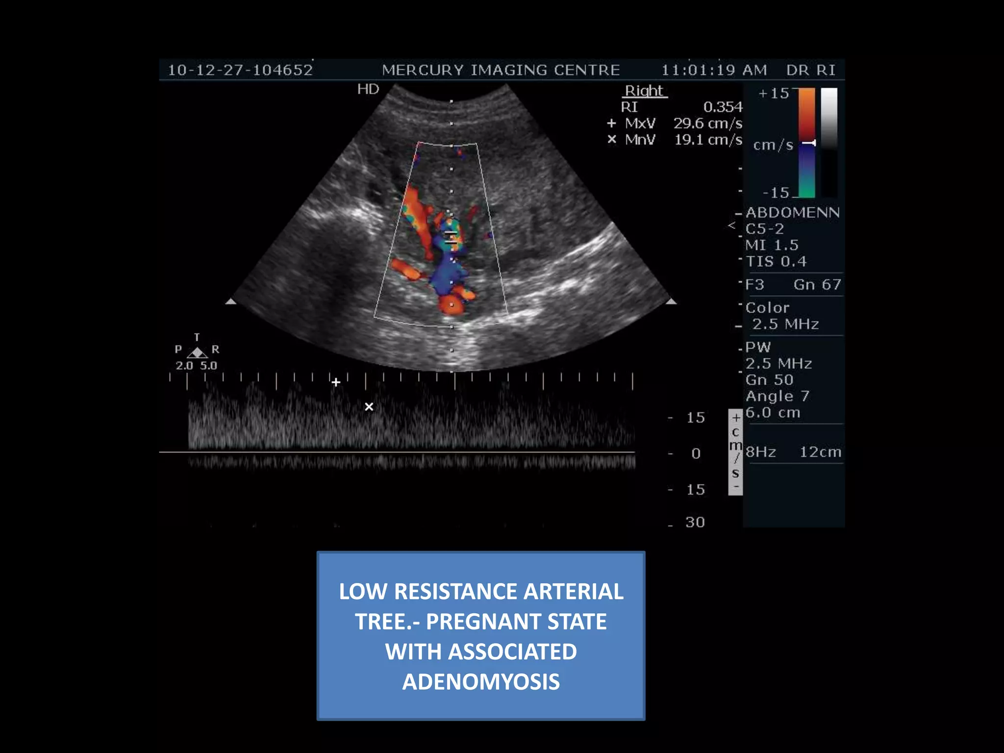 MAGNIFIED VIEW OF THE G SAC  SINGLE LINER ADENOMYOSIS CAN PREDISPOSE TO INTRAMYOMETRIAL ECTOPIC PREGNANCY 