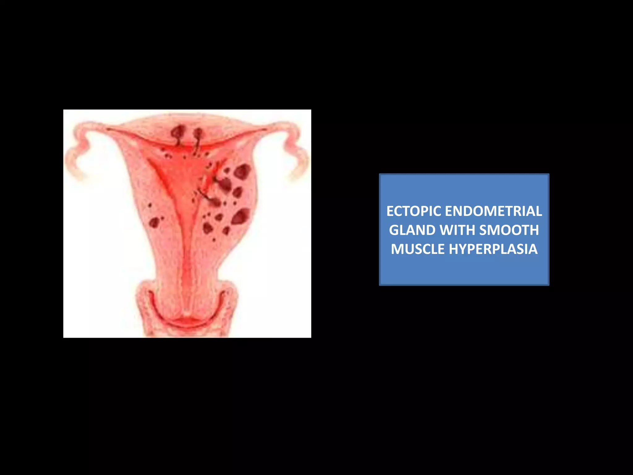 BULKY UTERUS  WITH LOBULATED OUTLINE  