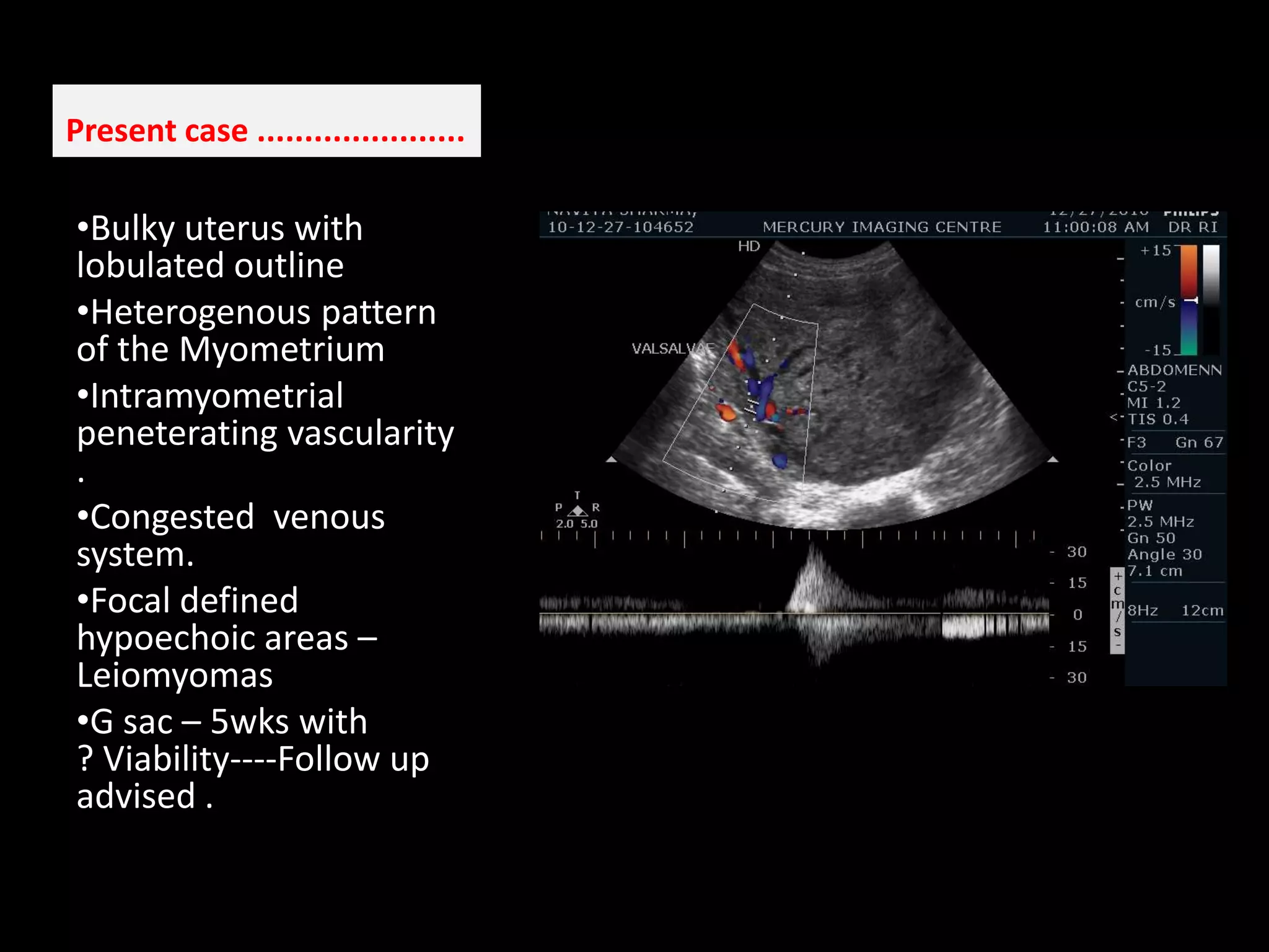 Present case ...................... Bulky uterus with lobulated outline  
