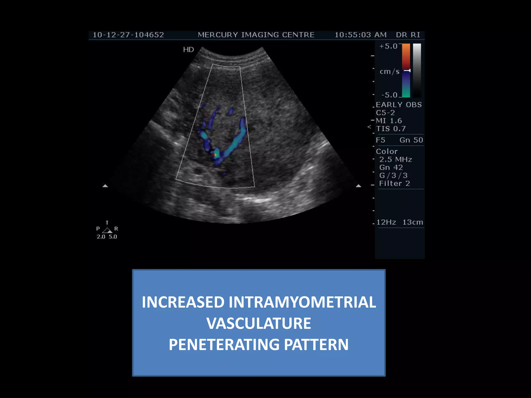 Heterogenous pattern of the Myometrium