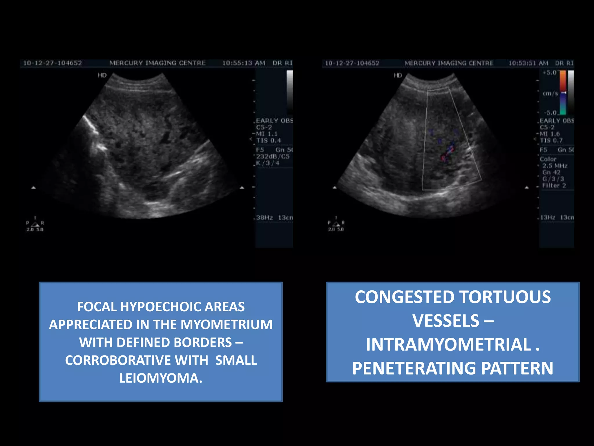 Intramyometrialpeneteratingvascularity.