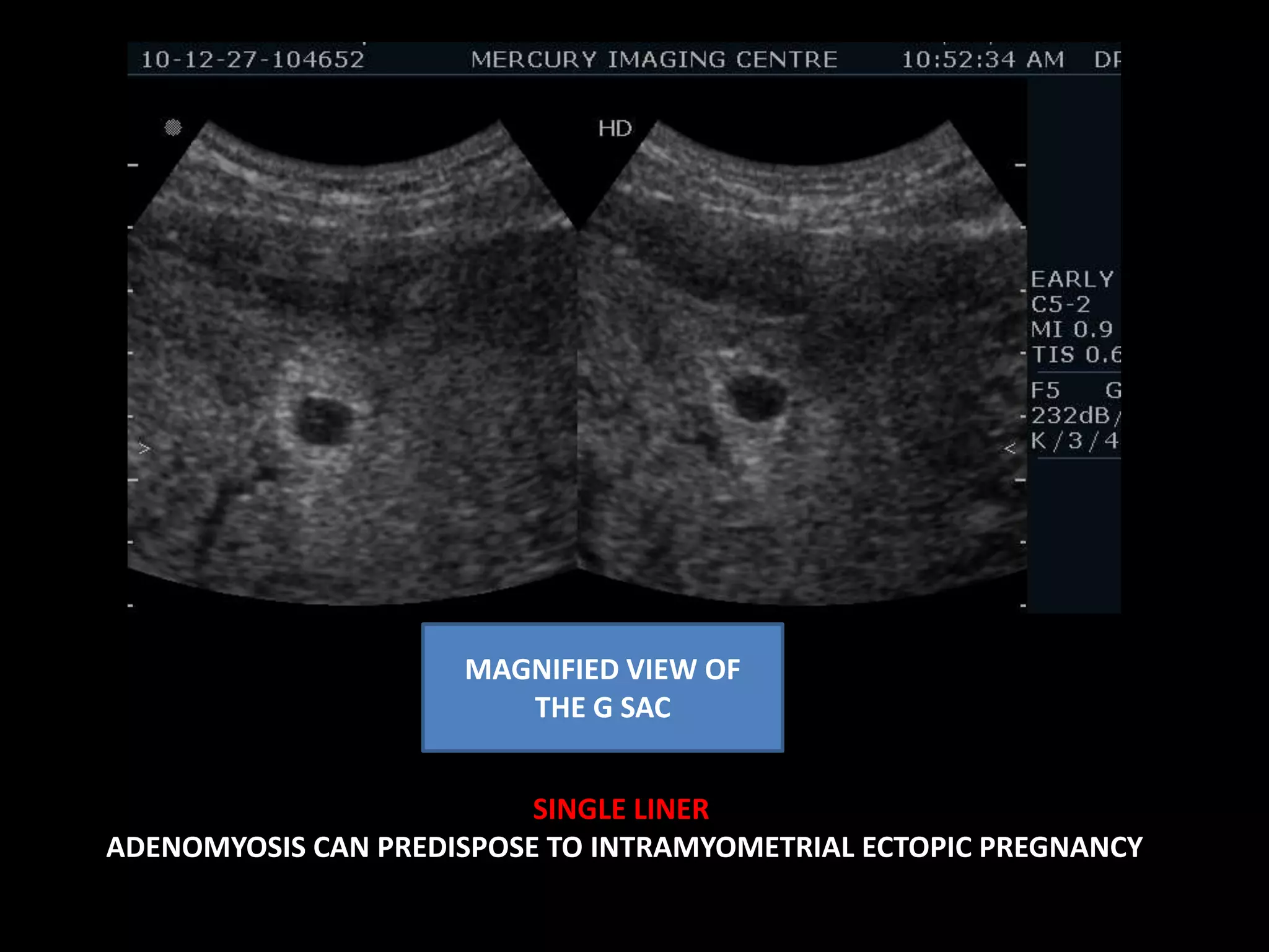 Focal defined hypoechoic areas – Leiomyomas