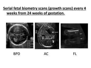 Pregnancy with beta thalassemia | PPTX