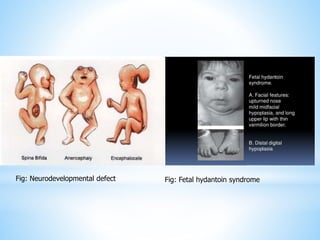 Fig: Neurodevelopmental defect Fig: Fetal hydantoin syndrome
 