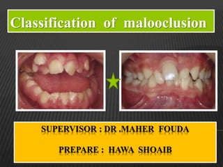 SUPERVISOR : DR .MAHER FOUDA
PREPARE : HAWA SHOAIB
Classification of malooclusion
 