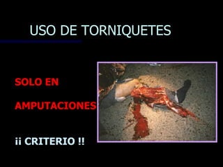 USO DE TORNIQUETES


SOLO EN

AMPUTACIONES


¡¡ CRITERIO !!
 
