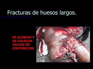 Fracturas de huesos largos.



 SE ALINEAN Y
 SE COLOCAN
 VALVAS DE
 CONTENCION
 