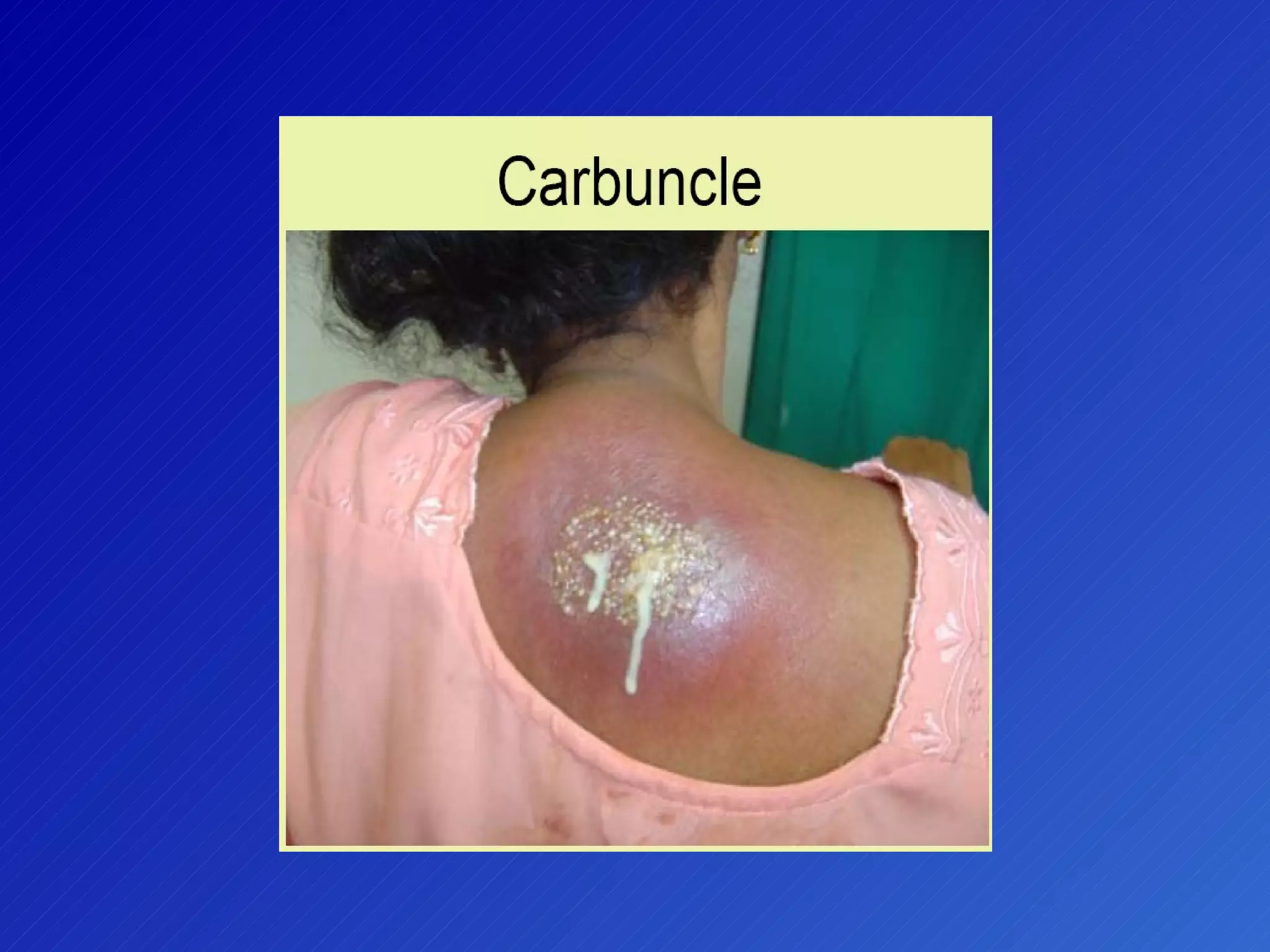 Prehospital Mrsa | PPT