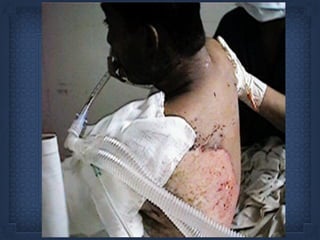 Burn Patient
 