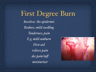 First Degree Burn
Involves the epidermis!
Redness, mild swelling!
Tenderness, pain!
E.g. mild sunburn!
First aid!
relieve pain!
dec pain/inﬂ!
moisturizer
 