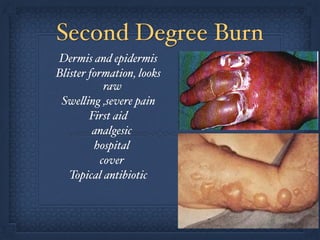 Second Degree Burn
Dermis and epidermis!
Blister formation, looks
raw!
Swelling ,severe pain!
First aid!
analgesic!
hospital!
cover!
Topical antibiotic
 