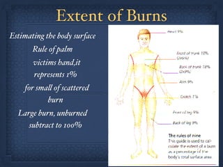 Extent of Burns
Estimating the body surface !
Rule of palm!
victims hand,it
represents 1% !
for small of scattered
burn!
Large burn, unburned
subtract to 100%
 