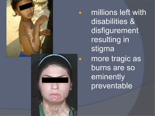 • millions left with
disabilities &
disfigurement
resulting in
stigma
• more tragic as
burns are so
eminently
preventable
 