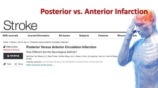 Posterior vs. Anterior Infarction
 