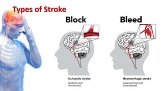 Types of Stroke
 