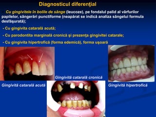 Diagnosticul diferenţial
 Cu gingivitele în bolile de sânge (leucoze), pe fondalul palid al vârfurilor
papilelor, sângerări punctiforme (neapărat se indică analiza sângelui formula
desfăşurată);
- Cu gingivita catarală acută;
- Cu parodontita marginală cronică şi prezenţa gingivitei catarale;
- Cu gingivita hipertrofică (forma edemică), forma uşoară
Gingivită catarală acută
Gingivită catarală cronică
Gingivită hipertrofică
 