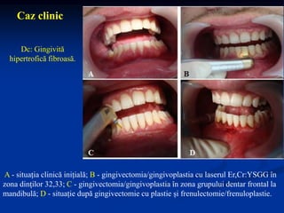A - situația clinică inițială; B - gingivectomia/gingivoplastia cu laserul Er,Cr:YSGG în
zona dinţilor 32,33; C - gingivectomia/gingivoplastia în zona grupului dentar frontal la
mandibulă; D - situație după gingivectomie cu plastie și frenulectomie/frenuloplastie.
Caz clinic
Dc: Gingivită
hipertrofică fibroasă.
 