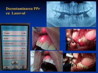 Decontaminarea PPr
cu Laser-ul
 