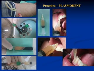 Procedeu – PLASMODENT
 