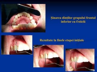 Șinarea dinților grupului frontal
inferior cu f/sticlă
Rezultate la finele etapei inițiale
 