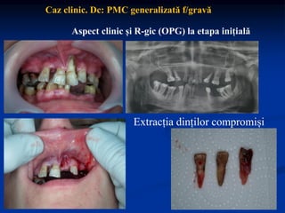 Aspect clinic și R-gic (OPG) la etapa inițială
Caz clinic. Dc: PMC generalizată f/gravă
Extracția dinților compromiși
 